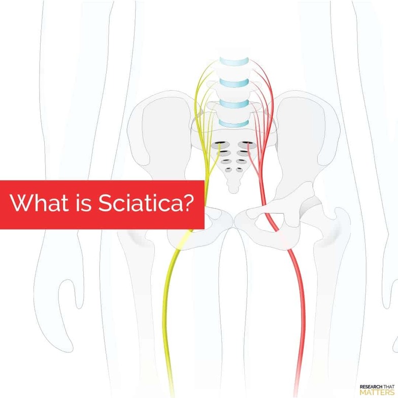 what is sciatica, sciatica doctor in Oklahoma City and Edmond
